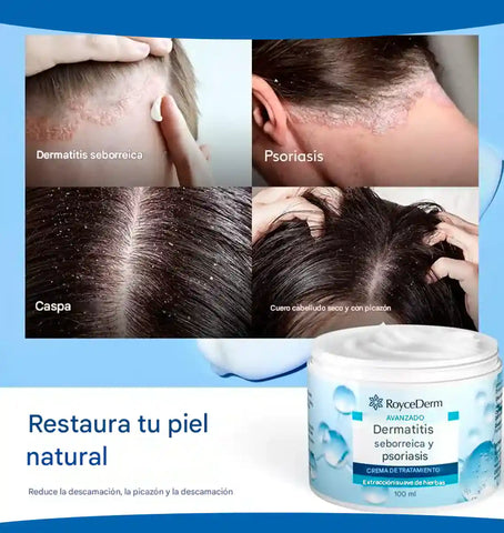 Image of ROYCEDERM® - Elimina la caspa y dermatitis seborreica
