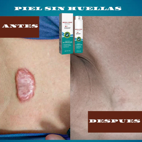 Image of SOUTH MOON® - Spray para cicatrices